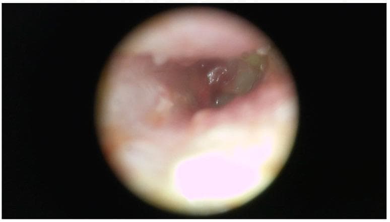This clinical photograph is an endoscopic view (otoscopy) of the right external auditory canal (EAC). The image demonstrates significant pathological changes characterized by extensive, thick purulent discharge (pus) and whitish keratin debris that nearly fill the lumen, obstructing a clear view of the tympanic membrane. The visible portions of the external ear canal wall appear markedly erythematous and swollen, with an irregular, thickened contour indicating active inflammation and edema. Such findings are characteristic of severe otitis externa or otomastoiditis, which may be associated with chronic infections such as tuberculosis or non-tuberculous mycobacteria (NTM) in refractory cases. The clinical significance of this visual is to illustrate the physical manifestations of chronic suppurative otitis, focusing on canal stenosis due to soft tissue swelling and the accumulation of infectious exudate.