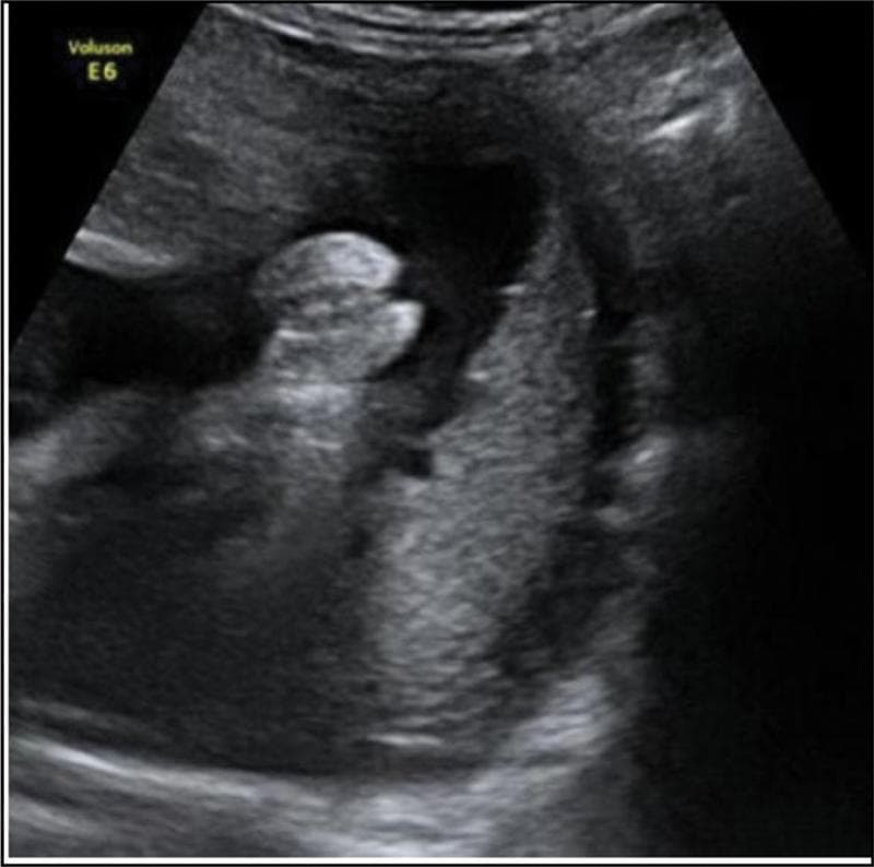 This diagnostic image is a gray-scale prenatal ultrasound from a midtrimester scan, specifically focusing on the fetal perineum to identify external genitalia. The scan displays a transverse view of the pelvic region. Key anatomical features include two parallel hyperechoic (bright) linear structures representing the labia majora. Centrally located between these lines is a smaller, distinct hyperechoic nodule corresponding to the clitoris, forming the characteristic 'hamburger sign' indicative of female fetal sex. The surrounding anechoic (dark) areas represent amniotic fluid, providing the necessary acoustic window for visualization. This image is clinically significant for routine obstetric screening, demonstrating the standard morphological markers used for sex determination and the assessment of external genital development during the second trimester of pregnancy.