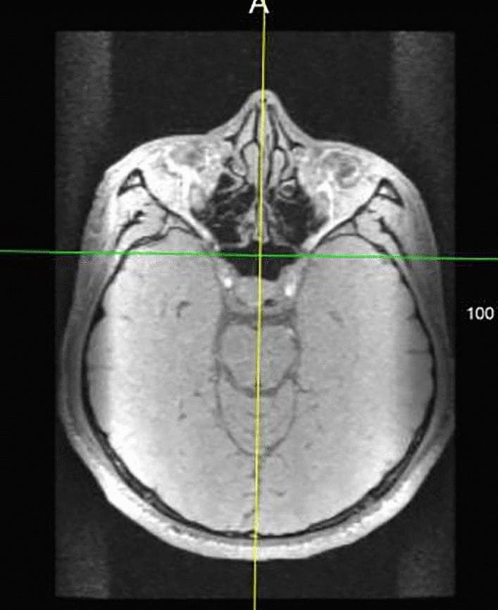 This diagnostic image is an axial cross-section of the human head, likely from a computerized tomography (CT) scan or magnetic resonance imaging (MRI), emphasizing craniofacial and intracranial anatomy. Visible structures include the orbits, nasal cavity, ethmoid and sphenoid sinuses, and the brain parenchyma within the skull vault. A yellow vertical reference line is superimposed along the midline, specifically aligned to coincide with the falx cerebri, a dural fold that separates the two cerebral hemispheres. A green horizontal line intersects the yellow line, passing through the posterior aspect of the orbits and the sphenoid sinus region. The image illustrates the 'anterior cerebral falx plane method' for establishing a craniofacial midline, a technique used in clinical imaging to assess facial symmetry, plan reconstructive surgery, or conduct cephalometric analysis. This anatomical alignment serves as a reliable internal reference point for measuring deviations in craniofacial morphology.