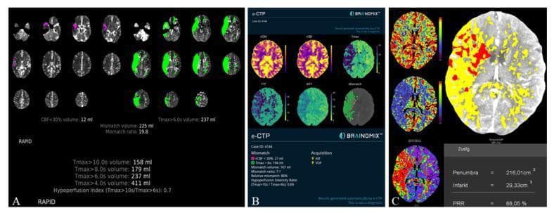 This diagnostic comparison image illustrates automated perfusion CT results for a patient with a right-hemisphere M1-occlusion, processed by three different software packages: RAPID (A), Brainomix (B), and Syngo (C). The composite highlights variations in visual representation and quantitative metrics for acute ischemic stroke. Panel A (RAPID) displays axial brain slices with color-coded maps showing delayed Tmax (>6.0s in green) and severely reduced CBF (<30% in purple), alongside metrics like mismatch volume (225 ml) and Hypoperfusion Index (0.7). Panel B (Brainomix) presents multi-parametric maps (rCBV, rCBF, Tmax, TTP, MTT) with a 167 ml mismatch volume and a Hypoperfusion Intensity Ratio (HIR) of 0.89. Panel C (Syngo) utilizes a large axial slice with a red/yellow overlay to demarcate the infarct core (29.33 cm³) and penumbra (216.01 cm³), showing a Penumbral Salvage Ratio (PRR) of 88.05%. The image demonstrates the clinical utility of automated software in assessing cerebral hemodynamics, identifying salvageable tissue (penumbra), and supporting triage decisions in neuro-radiology.