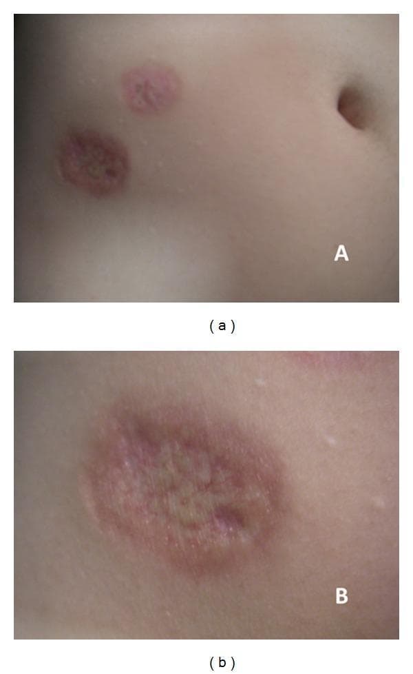 This clinical photograph displays two distinct, well-circumscribed skin lesions on the lower abdomen of a patient with type 1 diabetes, characteristic of Necrobiosis Lipoidica (NL). Panel (a) provides a wide view showing two oval-shaped plaques. Panel (b) offers a close-up macro view, highlighting the specific morphological features. The lesions demonstrate a central area of waxy, yellow-brown discoloration with visible cutaneous atrophy and telangiectasia. This central depression is sharply demarcated by a prominent, raised, and firm violaceous (purplish-red) border. The surrounding skin appears normal, emphasizing the clear margins of the inflammatory process. This visual presentation is a classic manifestation of NL, a granulomatous skin condition frequently associated with poor glycemic control. These educational images serve to illustrate the primary diagnostic features of the condition: atrophic center, yellowish hue, and peripheral violaceous elevation.