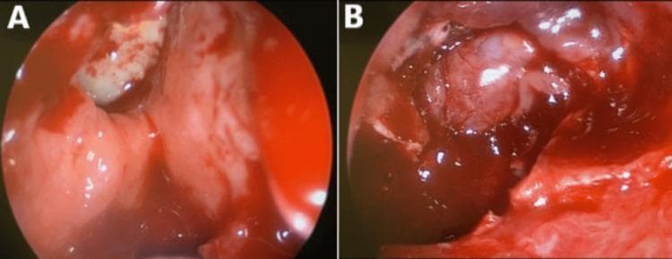 This composite intraoperative endoscopic clinical photograph illustrates a functional endoscopic sinus surgery (FESS). Image A displays the right sphenoid sinus cavity containing diffuse reddish-pink tissue, indicative of inflamed and swollen nasal mucosal polyps. A small area of whitish, denser material is visible among the irregular, vascularized tissue surfaces. Image B demonstrates a more advanced stage of the procedure, specifically showing the dehiscence of the sphenoid sinus roof. Centrally, a prominent, whitish, tubular structure is identified as the exposed optic nerve, which has become visible due to the erosion or removal of the overlying bone. The surgical field is highly vascularized with visible blood and fluid surrounding the exposed nerve and adjacent dural remnants. These images are clinically significant for demonstrating surgical management of Allergic Fungal Rhinosinusitis (AFRS) or similar inflammatory processes causing compressive optic neuropathy. The material serves as an educational resource for otorhinolaryngology and ophthalmology regarding sinus anatomy, surgical complications, and endoscopic landmarks.