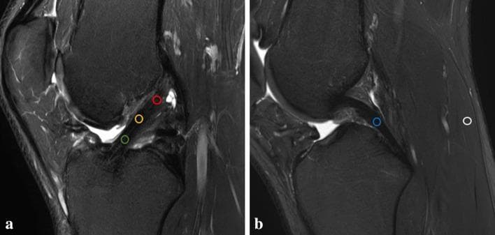 Two sagittal proton-density (PD) intermediate-weighted MRI scans of the knee (labeled A and B) demonstrating regions of interest (ROI) for measuring signal intensity of an anterior cruciate ligament (ACL) autograft. Image A shows three 4 mm circular ROIs along the intraarticular course of the ACL graft: proximal (red), mid-substance (yellow), and distal (green). Image B identifies internal reference points used for signal normalization: the mid-substance of the posterior cruciate ligament (PCL, blue circle) and the medial head of the gastrocnemius muscle (white circle). The images illustrate a standardized method for calculating the ACL/PCL signal ratio (APR) and the ACL/muscle ratio (AMR) to monitor the graft maturation and ligamentization process postoperatively. The primary anatomical structures visible include the femoral condyle, tibial plateau, reconstructed ACL, intact PCL, and posterior musculature.
