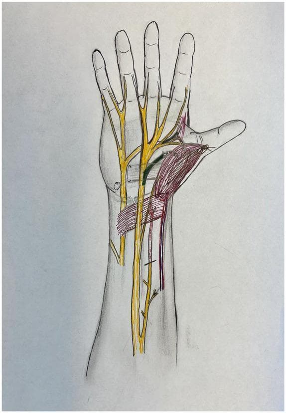 Anatomical diagram of the human hand and distal forearm in a palmar view, illustrating peripheral nerve anatomy and muscle transposition for pronator quadratus opponensplasty. The diagram features color-coded structures overlaid on a skeletal and soft tissue outline. Major peripheral nerves, including the median and ulnar nerves, are highlighted in yellow, showing their proximal courses and distal branching into digital nerves. The recipient anterior interosseous nerve (AIN) motor branch is highlighted in red, indicating its path toward the transposed muscle. The donor recurrent median nerve and donor deep ulnar nerve branches are highlighted in green, demonstrating potential donor sites for nerve coaptation to restore thenar function. The pronator quadratus muscle is shaded in red, shown in a transposed position toward the thumb (thenar eminence) to simulate its role as an opponens substitute. This illustration is designed for surgical planning in cases of chronic carpal tunnel syndrome or atrophic thenar muscle dysfunction, focusing on the spatial relationships required for effective nerve transfer and muscle mobilization.