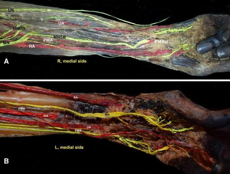 This clinical photograph displays a specialized anatomical dissection of the human forearm in two panels (A and B), focusing on vascular and neural variations. Panel A shows a right forearm (R) demonstrating an antebrachial-type persistent median artery (PMAat). The PMA is seen in an anterior position relative to the median nerve superficial branch (MNSB). Key structures identified include the radial artery (RA), ulnar artery (UA), and the division of the median nerve (MN) into superficial and deep branches (MNDB). Panel B illustrates a left forearm (L) with a palmar-type persistent median artery (PMA). This dissection highlights the relationship between the PMA, the ulnar artery, and the anterior interosseous artery (AIA). The AIA is shown penetrating the deep muscle surface of the pronator quadratus (noted by a small asterisk). These images illustrate the surgical anatomy and common variations of the persistent median artery, which are clinically significant for hand surgeons, particularly concerning carpal tunnel syndrome and vascular procedures in the upper limb.