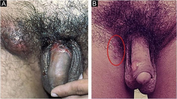 This clinical photograph displays two panels (A and B) illustrating the clinical manifestations of chancroid (Haemophilus ducreyi) in the male genital region. Panel A demonstrates a characteristic non-infiltrating primary ulcer located on the coronal sulcus and glans penis. The ulcer exhibits irregular, serpiginous, and undermined edges with a necrotic, 'dirty' base containing pyonecrotic exudate. Significant unilateral inflammatory inguinal lymphadenopathy (bubo) is visible as a prominent, erythematous swelling in the right groin area. Panel B illustrates the concept of reinoculation (autoinoculation), showing multiple smaller, satellite ulcers on the penile shaft. These lesions appear as superficial erosions that occur when the pathogen is spread from the primary site to adjacent skin. The images provide a comparison between primary infection with regional lymphatic involvement and the secondary spread of lesions. Key educational features include the morphology of soft chancre ulcers and the presentation of associated suppurative lymphadenitis characteristic of sexually transmitted infections (STIs).