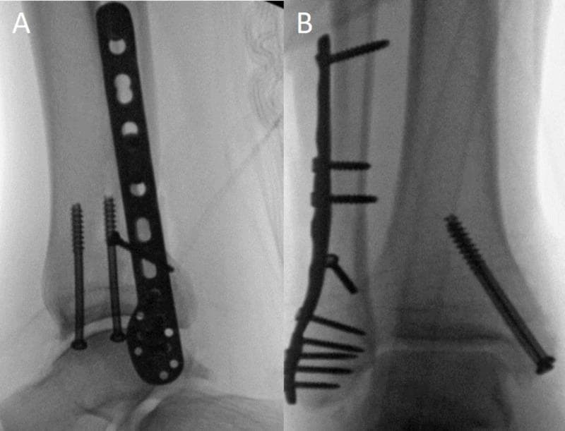 This educational image displays post-operative fluoroscopic radiographs of a right ankle following Open Reduction Internal Fixation (ORIF) of a bimalleolar fracture. Image A provides an anteroposterior (AP) view, demonstrating a fibular locking plate secured with multiple screws along the distal fibula, including a transverse lag screw for interfragmentary compression. Two vertically oriented, 4.0-mm partially-threaded cannulated lag screws are visible fixing the medial malleolus across the fracture line into the tibial metaphysis. Image B provides a lateral view, confirming the posterior-to-anterior placement of the locking plate on the fibula and the trajectories of the screws. The talus is well-reduced within the ankle mortise, and the hardware demonstrates stable alignment of both the medial and lateral columns of the ankle joint. These images illustrate standard orthopedic stabilization techniques for unstable ankle fractures, focusing on restoring anatomical alignment and syndesmotic stability.