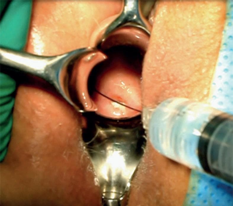 This clinical photograph demonstrates a gynecological interventional procedure with the patient in the lithotomy position. A metal speculum is utilized to retract the vaginal walls, providing clear visualization of the cervix (portio). The anterior lip of the cervix is secured with a surgical tenaculum to provide stabilization of the uterine anatomy. A syringe with a fine-gauge needle is visible in the foreground, performing a bilateral paracervical injection of local anesthetic (e.g., lidocaine). This paracervical block is a common clinical step to achieve regional anesthesia before invasive gynecological maneuvers such as cervical dilation or the insertion of an intracavitary brachytherapy applicator. The image highlights the precise anatomical positioning required for paracervical anesthesia, with the needle directed toward the lateral vaginal fornices where the sensory nerve supply to the cervix and lower uterus is located. The setup is performed under sterile conditions as part of a pre-planning or surgical phase in reproductive medicine or gynecological oncology.