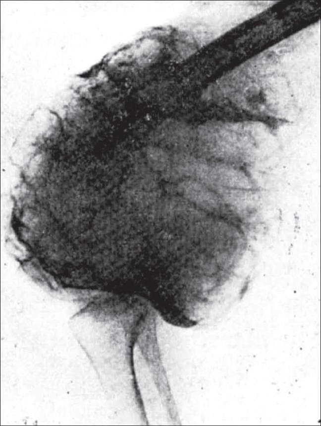 This diagnostic radiograph illustrates a classic presentation of a Giant Cell Tumor (Osteoclastoma) involving the epiphysis of a long bone. The image displays a large, expansile, lytic lesion characterized by a 'soap-bubble' appearance, created by internal bony trabeculations and uneven bone absorption. The lesion is eccentrically located and extends to the articular surface, though the subarticular bone remains remarkably intactβa hallmark feature of this pathology. The tumor is well-demarcated from the normal bone by a regular, convex transition zone with a graded density, rather than a sharp sclerotic rim. There is significant cortical thinning and bulging (ballooning) due to the expansive growth of the lesion, yet it lacks an aggressive periosteal reaction. This image serves as a key educational tool for differentiating non-infiltrative benign but locally aggressive bone tumors from sarcomas based on their characteristic dissolution patterns and logical progression toward the joint surface.