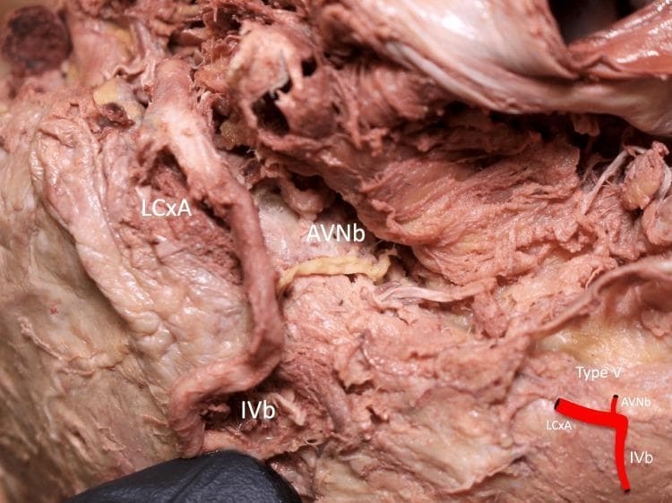 This clinical photograph of a formalin-fixed human heart cadaver specimen illustrates a Type V anatomical variation of the coronary arterial supply to the atrioventricular (AV) node. The image displays the inferior aspect of the heart, focusing on the inferior pyramidal space. Key vessels are labeled: the circumflex branch of the left coronary artery (LCxA), the atrioventricular nodal branch (AVNb), and the inferior interventricular branch (IVb). In this specific anatomical configuration, the AVNb is seen as a distinct, thinner vessel with a pale-yellow appearance originating directly from the LCxA, which has a larger diameter and more prominent reddish-brown coloration. The IVb is positioned inferiorly, and the AVNb acts as a connecting vessel between the LCxA and the distal myocardial structures. A small schematic inset in the bottom right corner provides a simplified diagram of this branching pattern. This material is significant for cardiovascular anatomy and surgical planning, demonstrating the variability of coronary dominance and blood supply to the cardiac conduction system.
