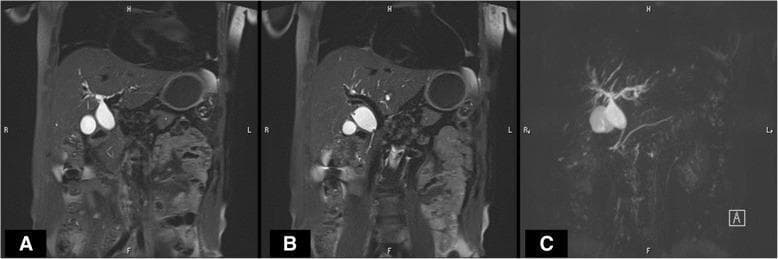 Diagnostic Magnetic Resonance Cholangiopancreatography (MRCP) showing the biliary and pancreatic ductal systems in coronal planes. Panels A and B are T2-weighted source images showing anatomical landmarks, while Panel C is a 3D maximum intensity projection (MIP) reconstruction focusing on fluid-filled structures. The imaging reveals significant fusiform dilatation of the common bile duct (CBD), extending from the common hepatic duct through the middle bile duct, consistent with a choledochal cyst. Panel C clearly demonstrates a pancreaticobiliary maljunction (PBM), characterized by an anomalous union where the pancreatic duct and common bile duct merge into a long common channel outside the duodenal wall. The intrahepatic biliary ducts show mild arborization, and the gallbladder is visible and unremarkable. This case illustrates the diagnostic utility of MRCP in identifying structural biliary anomalies and congenital maljunctions that predispose patients to biliary stasis and malignancy.