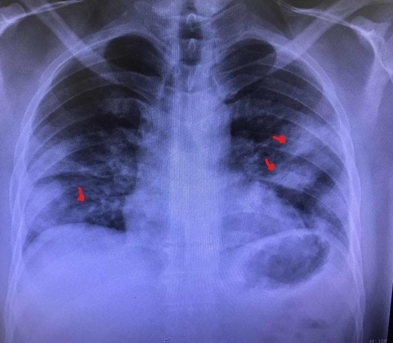 This diagnostic image is a posteroanterior (PA) chest X-ray demonstrating multifocal pneumonia. The radiograph reveals diffuse, bilateral, increased opacities throughout both lung fields. Notable findings include heterogeneous, ill-defined patchy opacities and areas of consolidation, predominantly in the mid and lower lung zones, as indicated by red arrows. These findings are consistent with alveolar filling and interstitial thickening, which obscure normal vascular markings. The cardiac silhouette and mediastinal contours appear within normal limits, though partially obscured by the adjacent pulmonary infiltrates. This image serves as a clinical example of multifocal infectious processes, commonly seen in community-acquired or viral pneumonia, illustrating the typical radiographic presentation of patchy air-space disease and its distribution across multiple lobes.
