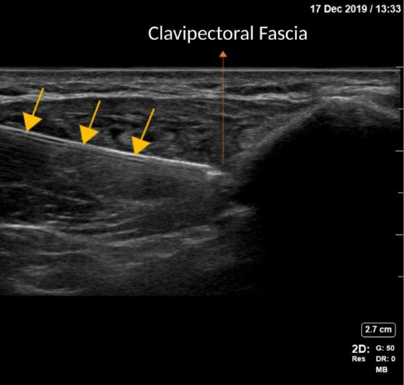 This diagnostic ultrasound image demonstrates the performance of a Clavipectoral Fascial Plane Block (CPB) using an in-plane needle technique. The imaging shows a cross-section of the anterior chest region near the clavicle. A highly echogenic (hyperechoic), linear needle is clearly visualized, highlighted by three yellow arrows, as it advances in a caudal-to-cephalad direction. The tip of the needle is positioned just superficial to the clavipectoral fascia, which is identified with an orange arrow. The anatomical landscape includes relatively hypoechoic superficial layers and deeper, more heterogeneous muscle tissue. The image illustrates the precise placement of a needle for anesthetic delivery within the fascial plane. This visual serves as a pedagogical resource for regional anesthesia, highlighting ultrasound-guided procedural landmarks, in-plane needle tracking, and the specific fascial anatomy required for effective CPB execution.