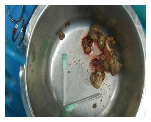 An intraoperative clinical photograph showing a collection of removed kidney stones placed in a stainless steel surgical tray. The primary specimen is a large staghorn calculus characterized by its irregular, branched morphology that reflects the shape of the renal pelvis and calyces. Multiple smaller fragmented calculi and gravel-like debris are also visible. The stones exhibit a variegated color palette ranging from light tan and yellowish-brown to dark brown, with visible traces of blood and biological tissue adherent to the surfaces. For scale and context, the tray contains surgical instruments, including a pair of scissors partially visible in the upper left and two hypodermic needles with green hubs. This image illustrates the typical gross appearance of large-scale urolithiasis following a surgical procedure like an anatrophic nephrolithotomy or percutaneous nephrolithotomy.