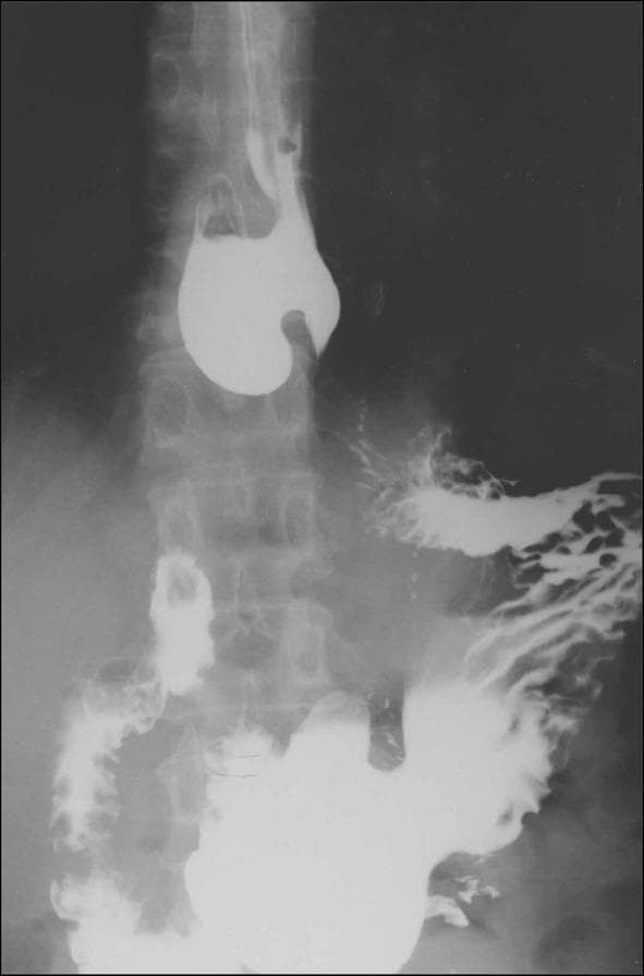 This diagnostic image is a barium swallow (upper gastrointestinal series) radiograph of the esophagus and stomach. The image demonstrates a prominent epiphrenic diverticulum, which appears as a large, rounded, radiopaque outpouching filled with contrast medium in the distal thoracic esophagus, just above the diaphragm. The esophagus itself shows significant architectural abnormalities, including distal dilatation and a non-straight, tortuous contour suggestive of a motility disorder such as achalasia. Contrast material is visible passing through the gastroesophageal junction into the stomach, where mucosal folds are outlined. The presence of this pulsion diverticulum in the lower third of the esophagus is a key finding often associated with increased intraluminal pressure. This educational material is relevant for gastroenterology and radiology specialties, focusing on structural esophageal pathologies and diagnostic fluoroscopy.