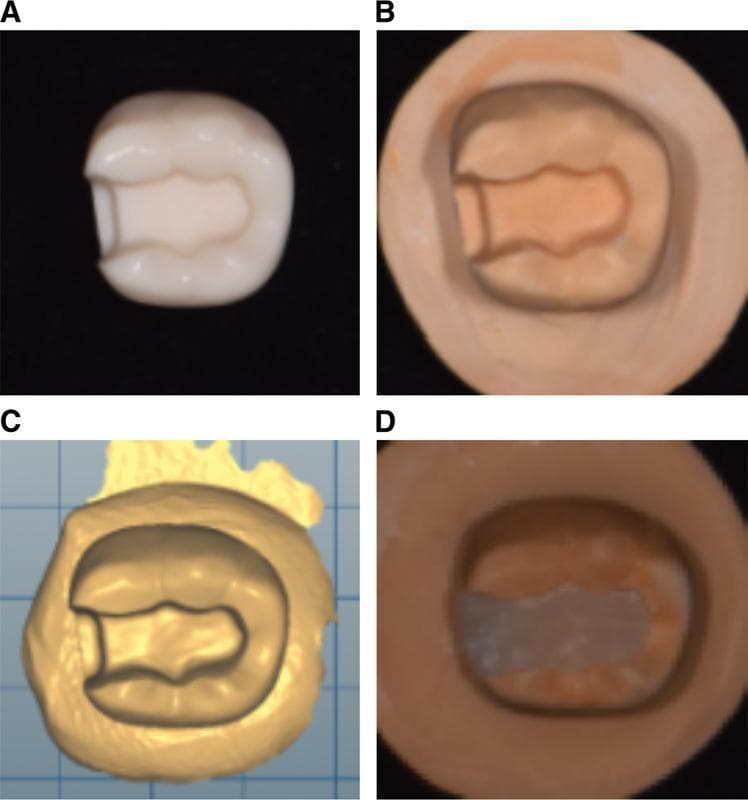 A four-panel figure illustrating the process of dental inlay fabrication and quality assessment. (A) Occlusal view of a mandibular right first molar resin tooth with a Class II mesio-occlusal (MO) inlay cavity preparation. The preparation shows a distinct occlusal box and mesial proximal box with defined margins and internal walls. (B) A master die made of high-strength dental stone, replicating the prepared tooth anatomy in a tan-colored material. (C) A digital 3D model of the master die rendered as a Standard Tessellation Language (STL) file, appearing as a gold-colored surface mesh on a blue grid background. (D) A completed dental inlay specimen fabricated via 3D printing using C&B resin, shown seated within the cavity or on the die for evaluation. This sequence demonstrates a digital-analog workflow in restorative dentistry, focusing on the precision of 3D printing for indirect restorations compared to traditional stone models.