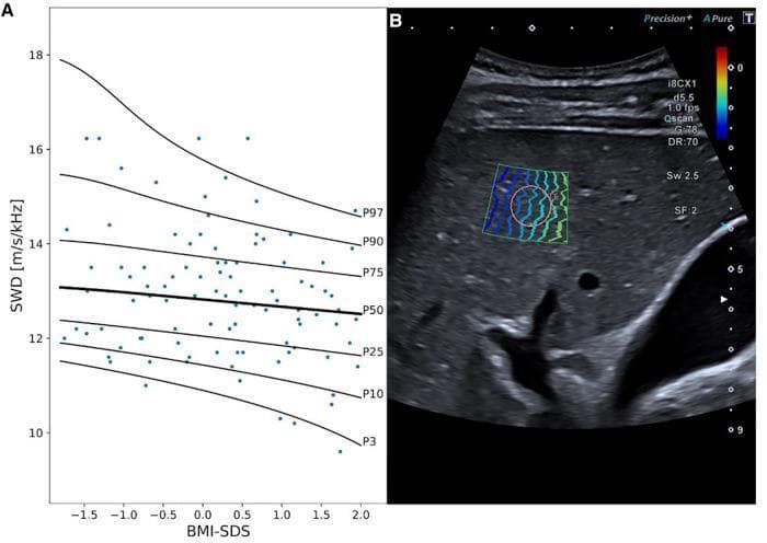 This composite educational graphic focuses on liver Shear Wave Dispersion (SWD) measurements, a diagnostic technique used to assess liver tissue viscosity and inflammation. Panel A presents a scatter plot with reference curves showing the relationship between SWD values (measured in m/s/kHz) and Body Mass Index Standard Deviation Score (BMI-SDS) in a pediatric population. The graph displays percentile curves (P3, P10, P25, P50, P75, P90, and P97), illustrating a general trend where SWD values decrease as BMI-SDS increases. Panel B provides a corresponding B-mode ultrasound image of a liver, utilizing a curvilinear transducer. A color-coded shear wave dispersion map is overlaid on the liver parenchyma, featuring a circular region of interest (ROI) for measurement. The interface displays technical parameters including mechanical index, gain (G:78), dynamic range (DR:70), and shear wave frequency (Sw 2.5). This material is relevant for pediatric hepatology and radiology, demonstrating the clinical application of ultrasound elastography and viscosity imaging in healthy and potentially symptomatic children.
