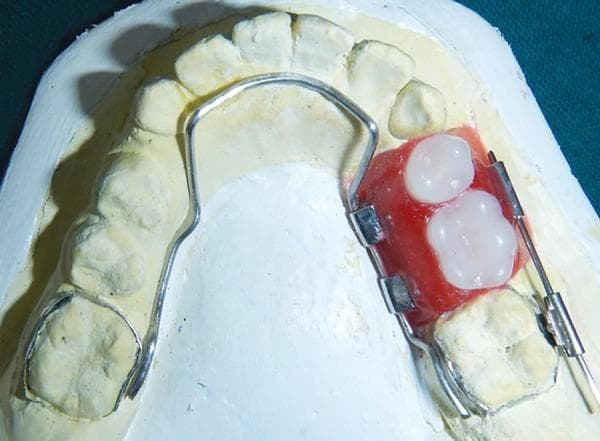 A clinical photograph of a specialized pediatric space maintainer, known as a functional lingual arch with hinge-type lockable dentulous component (LHLD), fabricated on a dental cast of the mandibular arch. The appliance features a 0.9 mm stainless steel lingual arch wire adapted to the lingual surfaces and soldered to molar bands on the first permanent molars. On the right side of the arch, an edentulous span is managed by a red wax-up (representing the future acrylic component) containing two white artificial molar teeth. This dentulous section is integrated with the lingual arch via a hinge mechanism consisting of metal molar tubes. On the buccal aspect, a locking mechanism is visible, comprising a metal wire passing through a tube on the dentulous component and a corresponding buccal tube on the molar band. This appliance is designed to maintain space and restore chewing function in a mixed dentition patient following the premature loss of primary molars while allowing for the eventual eruption of succedaneous premolars.