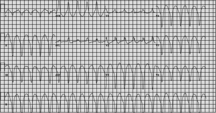 A 12-lead electrocardiogram (EKG) illustrating a wide complex tachycardia, clinically consistent with ventricular tachycardia (VT) occurring after return of spontaneous circulation (ROSC). The tracing displays a rapid, regular rhythm with broad QRS complexes, exceeding 120 ms, which suggests a ventricular origin rather than supraventricular conduction. Discernible P waves are absent throughout all leads, indicating a lack of atrioventricular synchrony. The precordial leads (V1-V6) show significant ST-segment and T-wave abnormalities, with high-amplitude T-waves and variable ST-segment deviations secondary to the aberrant depolarization. Lead II (rhythm strip at the bottom) confirms a sustained, monotonic wide-complex pattern. This diagnostic image demonstrates the electrical manifestations of severe electrolyte imbalances, specifically profound hypokalemia in the context of hyperosmolar hyperglycemic state (HHS). The EKG serves as an educational example of lethal cardiac arrhythmias associated with metabolic emergencies and the importance of rapid recognition of wide-complex tachycardias in clinical practice.