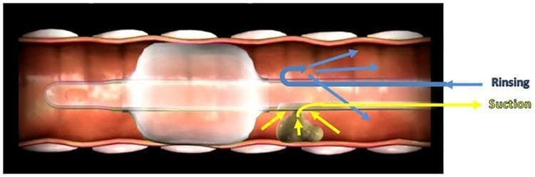 This medical illustration depicts a longitudinal cross-section of a human trachea containing an endotracheal tube (ETT) with an inflated cuff. The diagram focuses on the mechanism of Subglottic Secretion Drainage (SSD) enhanced by a rinsing system. The inflated ETT cuff is shown creating a seal against the tracheal wall to prevent microaspiration into the lower lungs. Just superior to the cuff, in the subglottic space, a mass of secretions is visible. The figure illustrates a dual-action clearance process: blue arrows labeled 'Rinsing' indicate the delivery of a saline solution into the subglottic space to dilute and mobilize the viscous secretions; yellow arrows labeled 'Suction' demonstrate the subsequent aspiration of these diluted secretions through a specialized dorsal suction lumen. This visual explains a clinical strategy used in intensive care to reduce the risk of Ventilator-Associated Pneumonia (VAP) by preventing the migration of pathogen-rich secretions past the ETT cuff.