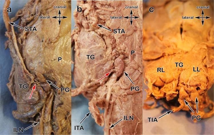 This set of three clinical photographs (a–c) depicts anatomical dissections of the thyroid region, focusing on the arterial blood supply variants to the parathyroid glands (PG). Panel (a) shows Type x supply where the parathyroid gland receives its primary arterial branch (red arrow) from the superior thyroid artery (STA), with the inferior laryngeal nerve (ILN) and pharynx (P) visible as landmarks. Panel (b) illustrates a variant where the blood supply arises directly from the thyroid gland (TG) parenchyma (red arrow); the superior thyroid artery (STA), inferior thyroid artery (ITA), and ILN are identified. Panel (c) demonstrates an anatomical variant where the parathyroid glands located at the inferior aspect of the right lobe (RL) and left lobe (LL) are supplied by a prominent thyroid ima artery (TIA) ascending from the mediastinum. These images provide critical surgical context for thyroidectomy and parathyroidectomy, highlighting the high degree of vascular variability and the necessity of preserving the parathyroid blood supply to prevent postoperative hypocalcemia.