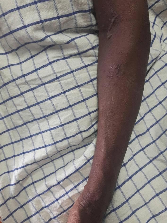 This clinical photograph displays a vesicular rash on the left upper limb of a patient with a darker skin tone. The lesions are primarily characterized as fluid-filled vesicles and small papules situated on an underlying erythematous base. The distribution is clustered and appears to follow a dermatomal pattern, typical of Herpes Zoster (shingles). Notable morphological features include areas of crusting and scabbing near the antecubital fossa, while more distal regions toward the forearm show active, raised vesicular clusters. The surrounding skin appears slightly dry with subtle pigmentary changes, but is otherwise intact. This visual serves as a primary educational example of the cutaneous manifestations of Varicella Zoster Virus reactivation, highlighting the progression from active vesicles to crusted lesions and the diagnostic importance of dermatomal distribution in clinical dermatology and infectious disease.