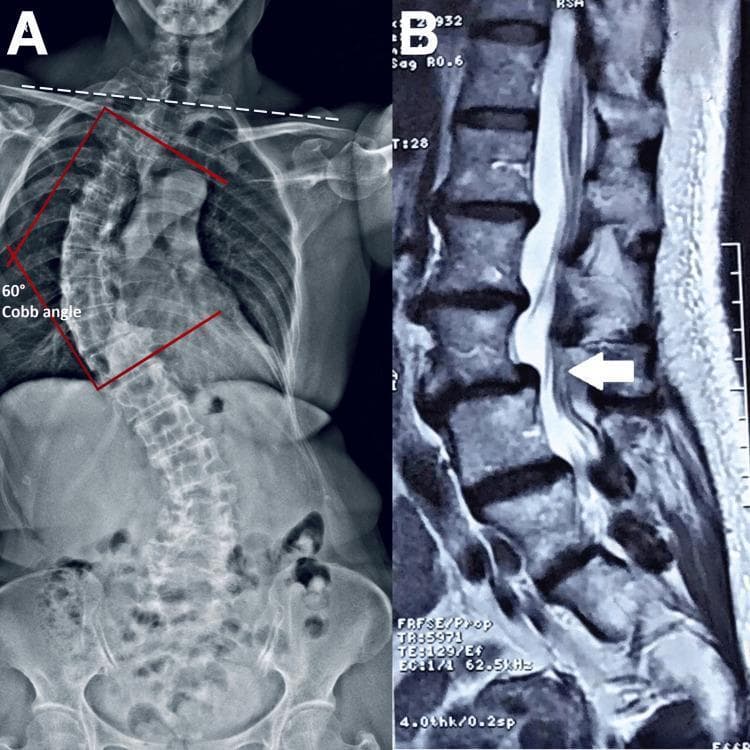 The image consists of two diagnostic views of the spine. Figure A is a posterior-anterior full-spine radiograph demonstrating severe degenerative scoliosis. A double curve pattern is visible, with a primary thoracic curvature quantified by a Cobb angle of 60 degrees (marked with red lines). A dashed white line across the shoulders indicates a significant shoulder and pelvic tilt, highlighting postural imbalance. Figure B is a sagittal T2-weighted MRI of the lumbar spine. It reveals multilevel degenerative disc disease and spondylolisthesis. At the L4-5 level, a white arrow points to a posterior disc bulge and ligamentum flavum hypertrophy, resulting in mild indentation of the thecal sac. Facet joint degeneration and osteophyte formation are also evident at the L2-3 level, contributing to mild spinal stenosis. The combined images illustrate the correlation between macroscopic spinal deformity (scoliosis) and localized structural pathology (spondylolisthesis and disc herniation) in a clinical context of chronic back pain.