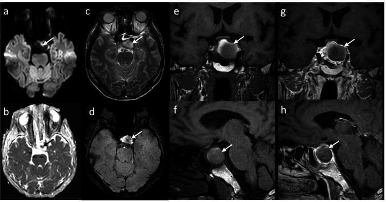 This figure presents multi-sequence cranial MRI images (axial, coronal, and sagittal planes) of a sellar mass, illustrating the diagnostic features of pituitary apoplexy. Axial Diffusion-Weighted Imaging (DWI) (a, b) demonstrates a focal area of central hyperintensity within the pituitary gland, indicating restricted diffusion consistent with acute infarction. On axial T2-weighted imaging (c), the lesion is relatively hyperintense, while the axial Susceptibility-Weighted Imaging (SWI) (d) reveals a central hypointense signal, or susceptibility artifact, indicative of intralesional hemorrhage. The coronal and sagittal T1-weighted pre-contrast images (e, f) show incomplete peripheral hyperintensity within the mass. Post-contrast T1-weighted images (g, h) display a characteristic peripheral ring enhancement pattern, which appears slightly less pronounced on follow-up compared to initial imaging. The combined findings of infarction (DWI restriction) and focal hemorrhage (SWI artifact) in a pituitary macroadenoma are hallmark radiologic features of pituitary apoplexy, a clinical emergency requiring neurosurgical and endocrinological evaluation.