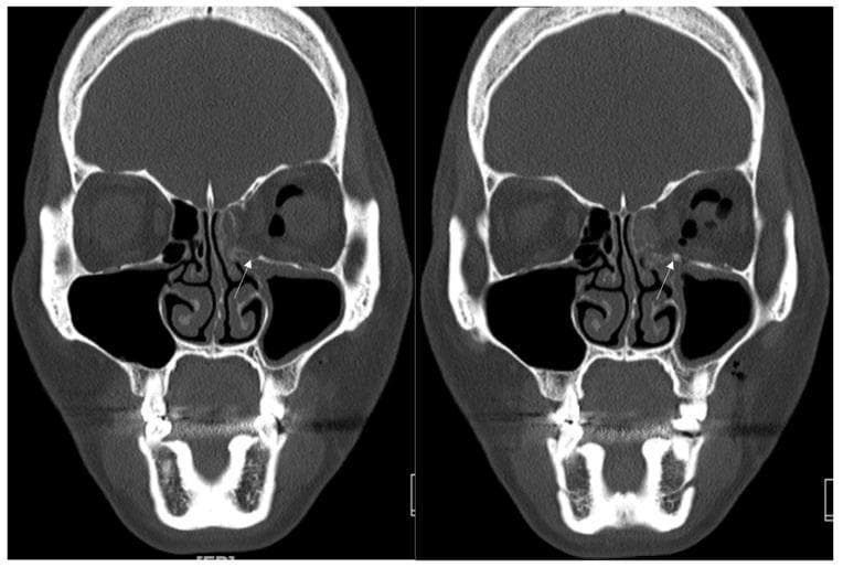 This diagnostic image consists of two side-by-side coronal slices from a facial computerized tomography (CT) scan (bone window) demonstrating surgical reconstruction of an orbital blowout fracture. The left orbit (viewer's right) exhibits a fracture involving the inferomedial wall. A hyperdense, radio-opaque implant, identified as a titanium-reinforced porous polyethylene (TR-PPE) plate, is seen positioned along the left medial orbital floor and lower medial wall to reconstruct the defect. A small, focal, high-density point (marked by a white arrow) indicates a single titanium screw used to fixate the plate to the inferior orbital rim. Anatomical landmarks include the bilateral maxillary sinuses, ethmoid air cells, and the nasal cavity. The left orbit shows some soft tissue herniation and postoperative changes compared to the intact right orbit. This image illustrates maxillofacial trauma management and the use of alloplastic materials in orbital floor reconstruction to restore orbital volume and prevent enophthalmos.