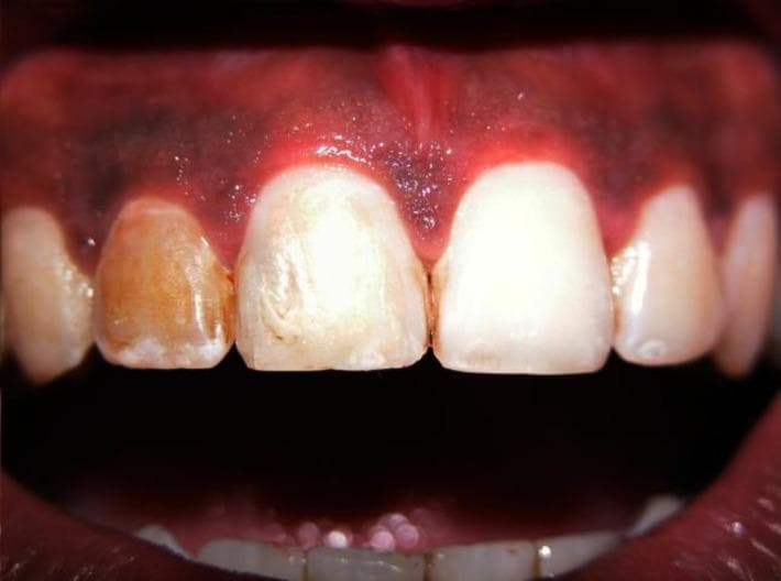 This intraoral clinical photograph displays the maxillary anterior teeth with a primary focus on the upper right central (tooth #11) and lateral (tooth #12) incisors. The image illustrates significant intrinsic dental discoloration, often associated with pulpal necrosis and chronic periapical periodontitis following trauma. The lateral incisor shows a prominent brownish-yellow hue across its labial surface, particularly concentrated near the gingival margin. The central incisor exhibits more diffuse, mottled discoloration with lighter shades towards the incisal edge. The surrounding gingiva appears erythematous, glossy, and slightly edematous around the cervical margins of the affected teeth, indicating localized inflammation. This visual serves as an educational example of the long-term aesthetic sequelae of non-vital teeth and the clinical presentation of post-endodontic cases where internal staining persists. The photograph is intended for dental students and endodontic practitioners to recognize visual indicators of tooth non-vitality and associated soft tissue changes.