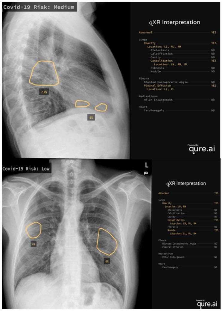 This composite diagnostic image features two examples of AI-assisted chest X-ray (CXR) interpretation using the qure.ai qXR algorithm. The top panel displays a lateral CXR labeled 'Covid-19 Risk: Medium', showing opacities and consolidations highlighted by orange contour overlays with percentage quantifications (23% and 4%). Corresponding structured data indicates abnormalities in the left lower (LL), right upper (RU), and right middle (RM) lung fields, alongside pleural effusions. The bottom panel displays a posterior-anterior (PA) CXR labeled 'Covid-19 Risk: Low', featuring multifocal opacities and nodules in the left middle (LM), right upper (RU), and right middle (RM) regions, with 4% and 8% lung involvement marked. Both panels include a 'qXR Interpretation' checklist that categorizes findings across four domains: Lungs (opacity, consolidation, nodules), Pleura (effusion, blunted angles), Mediastinum (hilar enlargement), and Heart (cardiomegaly). This comparison illustrates how deep learning algorithms quantify disease severity, such as COVID-19 pneumonia, by identifying specific radiological markers and calculating risk scores to support clinical triage.
