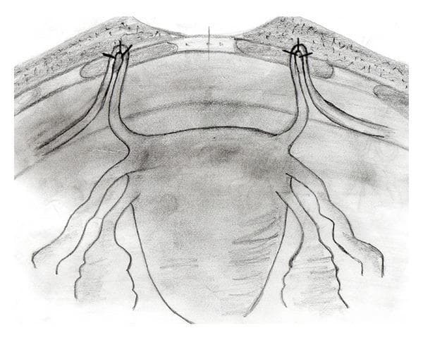 Anatomical Diagram: A black-and-white schematic illustration demonstrating the surgical fixation of the round ligaments to the anterior rectus fascia, likely for the management of pelvic organ prolapse. The diagram provides an anterior view of the uterus and its supporting structures. The uterine fundus is shown in the center, with the round ligaments extending bilaterally. These ligaments are depicted being pulled cranially and looped through small fenestrations in the rectus abdominis muscle layer. The apical 'ans' or loop of each round ligament is secured to the overlying fascia using three distinct sutures, represented by 'x' markers. Additional adnexal structures, including the fallopian tubes and utero-ovarian ligaments, are visible extending from the uterine cornua. The illustration emphasizes the anatomical relationship between the pelvic viscera and the abdominal wall fascia during a suspension procedure, highlighting the point of mechanical support and the method of non-absorbable suture fixation used to stabilize the uterine position.