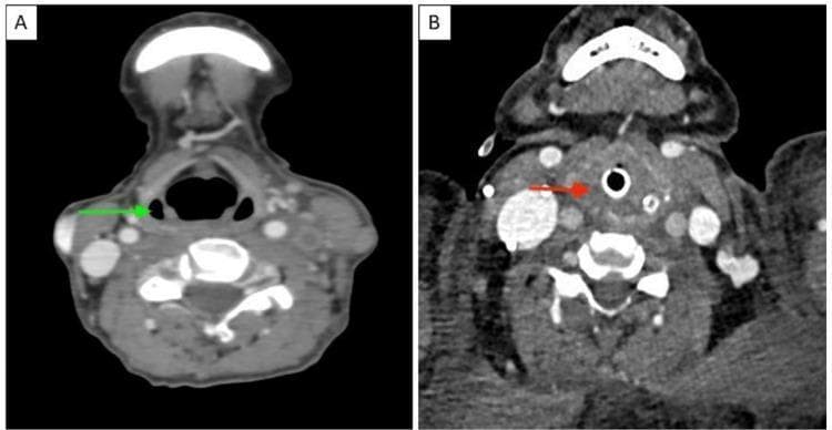 This Comparison Chart features two side-by-side axial contrast-enhanced computed tomography (CECT) images of the neck, illustrating the differences between normal anatomy and pathological upper airway edema. Image A (left) displays normal anatomy at the level of the larynx and hypopharynx. A green arrow indicates the bilateral, air-filled pyriform sinuses, which appear as clear, crescentic radiolucent areas. Image B (right) demonstrates a pathological state characterized by significant laryngeal and hypopharyngeal soft tissue edema. A red arrow points to the complete effacement and obliteration of the pyriform sinuses due to tissue swelling. Additionally, Image B shows an endotracheal tube in situ within the tracheal lumen, identifiable as a hyperdense circular ring with a central air column. The surrounding subcutaneous tissues in Image B exhibit increased density and reticulation consistent with subcutaneous edema. This comparison is clinically relevant for diagnosing airway compromise and identifying radiological signs of severe inflammation or angioedema in the cervical region.