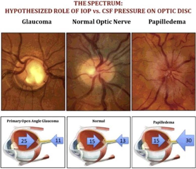 This educational graphic illustrates the 'Cerebrospinal Fluid (CSF) Theory' of the optic nerve head, comparing Glaucoma, a Normal Optic Nerve, and Papilledema through a combination of fundus photographs and cross-sectional ocular diagrams. The top row features three clinical fundus images: Glaucoma displays a pale, enlarged optic cup with bayoneting vessels; the Normal Optic Nerve shows healthy pink neuroretinal rim and distinct margins; and Papilledema exhibits a hyperemic, swollen optic disc with blurred margins and tortuous vessels. The bottom row consists of three corresponding anatomical diagrams showing the Translaminar Pressure Gradient (TLPG). Large blue arrows represent Intraocular Pressure (IOP) pushing posteriorly, while opposing blue arrows represent Intracranial Pressure (ICP) pushing anteriorly. In Primary Open Angle Glaucoma, high IOP (25) outweighs low ICP (11), leading to posterior bowing (cupping). In the Normal state, pressures are balanced (IOP 15 vs. ICP 13). In Papilledema, high ICP (30) outweighs IOP (15), causing anterior displacement and swelling. This comparison highlights how the relationship between IOP and ICP contributes to optic nerve pathology.