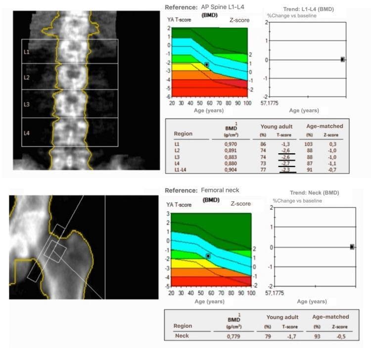 This diagnostic report presents results from a dual-energy X-ray absorptiometry (DEXA) scan used for bone mineral density (BMD) assessment. The report is divided into two main sections: the Anteroposterior (AP) Lumbar Spine (L1-L4) and the Femoral Neck. Each section includes a localized scan image with defined regions of interest, a color-coded reference graph, a longitudinal trend plot, and a data table. The color-coded reference graphs plot the patient's YA T-score and Z-score against age-matched reference ranges, with green representing normal density, yellow/orange for osteopenia, and red for osteoporosis. For the AP Spine, the table indicates a combined L1-L4 T-score of -2.3 and a BMD of 0.904 g/cm², while the Femoral Neck shows a T-score of -1.7 and a BMD of 0.779 g/cm². These findings are clinically significant for the diagnosis of osteopenia, approaching the threshold for osteoporosis in the lumbar region. The longitudinal 'Trend' graphs track the percentage change vs baseline over time, serving as a tool for monitoring disease progression or treatment efficacy in skeletal health management.