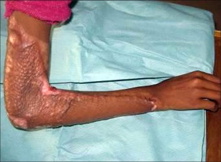 A clinical photograph of the right upper extremity of a patient showing a significant post-burn flexion contracture at the elbow joint. The skin over the upper arm and antecubital fossa displays extensive hypertrophic scarring with a thickened, pebbled, or 'mosaic-like' texture and hyperpigmentation, consistent with healed deep-partial or full-thickness thermal injury. There is a visible linear surgical scar extending down the volar forearm towards the wrist, featuring evenly spaced suture marks, likely representing a previous reconstructive procedure such as a contracture release or skin graft. At the distal forearm near the wrist, there is a prominent skin protrusion and irregular scar tissue. The photograph illustrates the complications of secondary intention healing in burn patients and highlights the importance of anti-contracture positioning and splinting to maintain range of motion and prevent permanent joint deformity.