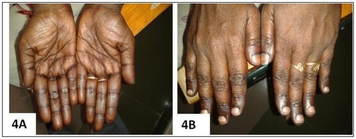 Clinical photograph comparison (Figure 4A and 4B) demonstrating the cutaneous manifestations of Vitamin B12 deficiency and its resolution following treatment. Image 4A (Pre-treatment): Palmar view showing diffuse, brownish-black hyperpigmentation with prominent accentuation along the palmar creases and longitudinal hyperpigmentation of the fingers. The knuckles exhibit characteristic darkening, a classic sign of megaloblastic anemia-associated pigmentary changes. Image 4B (Post-treatment): Dorsal view of the same patient's hands 12 weeks after initiating parenteral cyanocobalamin (Vitamin B12) therapy. There is a marked reversal of the hyperpigmentation, with the skin returning to a more uniform, lighter tone. The previously dusky knuckles and digits show significant clearing, and the nail beds appear healthy. This comparison serves as an educational tool for identifying dermatological markers of nutritional deficiencies and monitoring therapeutic response to Vitamin B12 supplementation.