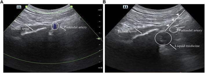 This educational medical visual consists of two ultrasound frames (A and B) demonstrating a guided pudendal nerve block procedure. Image A (pre-injection) shows the pelvic floor anatomy via a phased-array probe. Key landmarks include the ischial spine, visualized as a linear, hyperechoic (bright) band, and the pudendal artery, identified as a small, hypoechoic (dark) circular structure near the spine's tip. Image B (post-injection) illustrates the clinical application, featuring a needle trajectory marked by a white line with arrowheads. A larger hypoechoic area, labeled 'liquid medicine,' is visible adjacent to the pudendal artery, representing the local anesthetic spread around the pudendal nerve. The images serve as an anatomical guide for regional anesthesia, highlighting the spatial relationship between bony landmarks (ischial spine), vascular structures (pudendal artery), and the target nerve site for effective needle placement and anesthetic distribution in the management of post-operative pelvic or anorectal pain.