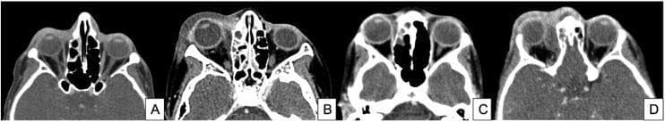 A comparative series of four axial Computed Tomography (CT) scans of the orbits, illustrating the radiological progression of orbital complications typically following sinusitis, categorized by severity. Panel A (Eyelid Cellulitis) shows preseptal soft tissue swelling and eyelid edema with preserved clarity of the post-septal orbital fat. Panel B (Orbital Cellulitis) demonstrates increased density and 'dirty' stranding of the intraconal and extraconal orbital fat, indicating post-septal inflammation without a focal collection. Panel C (Subperiosteal Abscess) reveals a localized, rim-enhancing fluid collection adjacent to the medial orbital wall (lamina papyracea), displacing the medial rectus muscle laterally. Panel D (Orbital Abscess) displays a more advanced, poorly defined heterogeneous collection within the orbital soft tissues, causing significant proptosis and mass effect. These diagnostic images provide clinical examples of the Chandler classification for orbital infections, emphasizing the importance of identifying organized abscesses for surgical planning.