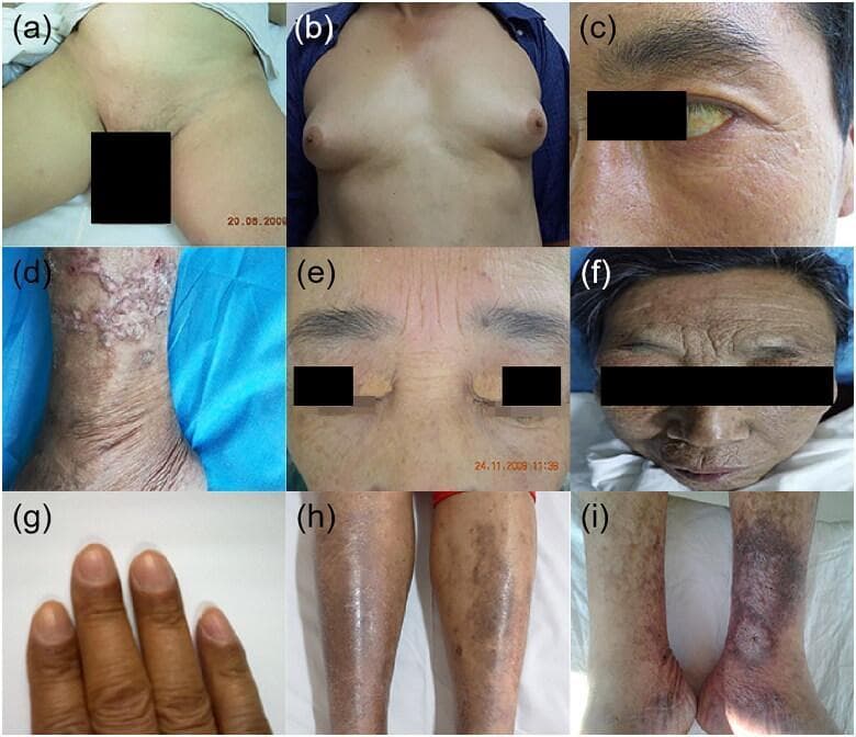 A composite of nine clinical photographs (a-i) illustrating various dermatological and systemic manifestations associated with chronic liver disease and cirrhosis. (a) Displays loss of pubic hair. (b) Shows bilateral gynecomastia in a male patient. (c) Features scleral icterus (jaundice) visible in the eye. (d) Demonstrates prurigo nodularis on the lower leg, characterized by multiple hyperkeratotic, crusty, and excoriated nodules on thickened skin. (e) Shows bilateral xanthelasma, manifesting as yellowish, planar lipid deposits around the eyelids. (f) Exhibits 'hepatic facies' with a muddy-gray, hyperpigmented complexion and pronounced facial wrinkling. (g) Displays digital hyperpigmentation. (h) Shows anterior tibial pigmentation, likely due to hemosiderin deposition. (i) Illustrates a chronic leg ulcer on the lower extremity with surrounding stasis changes and necrotic tissue. This collection serves as a diagnostic educational resource for identifying the physical signs of impaired hormone metabolism and portal hypertension in liver pathology.