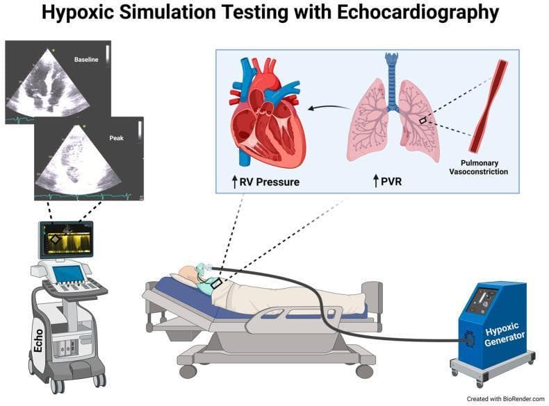 Educational medical infographic illustrating the setup and pathophysiology of Hypoxic Simulation Testing using Transthoracic Echocardiography (TTE). The clinical setup shows a patient in a semi-recumbent position on a hospital bed, breathing a low-oxygen gas mixture delivered via a face mask from a hypoxic generator. A bedside echocardiography machine is actively monitoring cardiac function. The visual includes two comparative four-chamber view ultrasound frames: 'Baseline' (normal cardiac morphology) and 'Peak' (showing changes during maximum hypoxia). A physiological inset diagram explains the underlying mechanism: inhalation of the hypoxic mixture triggers pulmonary vasoconstriction and increased Pulmonary Vascular Resistance (PVR), which subsequently leads to elevated Right Ventricular (RV) pressure. This illustration is used to teach diagnostic approaches for evaluating pulmonary hypertension susceptibility and right-to-left shunting (e.g., patent foramen ovale) under physiological stress.