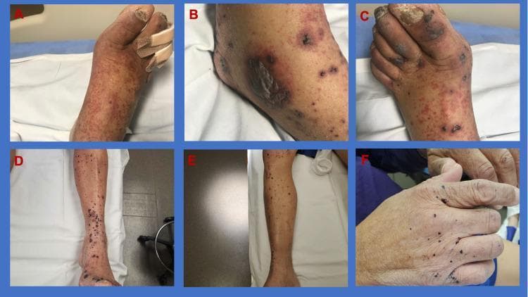 This clinical photograph series illustrates the progression and treatment response of palpable purpura in a patient with IgA vasculitis (Henoch-Schönlein purpura). Panels A-C display the clinical presentation at admission: Panel A shows a dorsal view of the foot with dense, confluent, reddish-purple purpuric macules and papules; Panel B highlights the lateral ankle featuring larger ecchymotic areas and bullous lesions indicating skin breakdown; and Panel C focuses on the toes, demonstrating dark, necrotic-appearing patches and digital ulceration. Panels D-F illustrate the clinical state post-steroid therapy: Panels D and E show a significant reduction in the density and inflammatory appearance of the lesions on the lower legs, which have transitioned to darker, resolving crusts and post-inflammatory pigmentary changes. Panel F displays the hand, showing resolving, sparse, small purpuric spots. This comparison highlights the hallmark dermatologic manifestation of leukocytoclastic vasculitis, characterized by symmetric, gravity-dependent palpable purpura, and demonstrates the efficacy of systemic corticosteroids in managing cutaneous inflammation and associated systemic symptoms like edema and arthralgia.