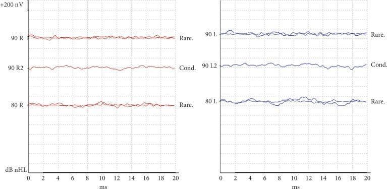 This diagnostic image displays a Brainstem Auditory Evoked Response (BAER) or Brainstem Evoked Response Audiometry (BERA) recording, a neurophysiological test used to evaluate hearing and brainstem function. The data is presented in two separate graph panels for the right ear (labeled 'R' in red) and the left ear (labeled 'L' in blue). The x-axis represents time in milliseconds (0 to 20 ms), and the y-axis represents amplitude in nanovolts (nV). Measurements are shown for auditory stimulations at 90 dB nHL and 80 dB nHL, utilizing both rarefaction (Rare.) and condensation (Cond.) click polarities. In both panels, the traces are essentially flat or demonstrate low-amplitude non-specific noise, with a complete absence of the characteristic Waves I-V typically seen in a normal response. This visual pattern is a clinical indicator of severe to profound bilateral hearing loss or significant pathology along the auditory pathway, as it demonstrates an absence of measurable neural response even at high intensity (90 dB) stimulation.