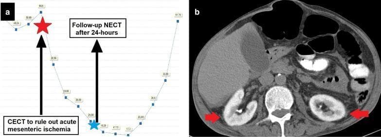 A composite medical visual illustrating the development and monitoring of contrast-induced nephropathy (CIN).
Panel (a) features a longitudinal line graph plotting Glomerular Filtration Rate (GFR) values over time. It shows a baseline GFR of 54.5 mL/min/1.73 m², followed by a precipitous decline after a contrast-enhanced computed tomography (CECT) scan (indicated by a red star). The GFR reaches a nadir before beginning a gradual recovery 24 hours later (indicated by a blue star).
Panel (b) is an axial non-contrast computed tomography (NCCT) scan of the mid-abdomen. Red arrows indicate bilateral renal parenchymal hyperdensity. This persistent enhancement in a non-contrast study is characteristic of contrast retention within the renal parenchyma, reflecting impaired filtration and excretory function secondary to acute kidney injury. The kidneys appear diffusely high in attenuation compared to surrounding soft tissues.
This image serves as a clinical teaching tool for recognizing radiological manifestations of renal dysfunction following intravascular contrast administration in a patient with suspected sepsis and mesenteric ischemia.