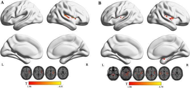This diagnostic image displays functional magnetic resonance imaging (fMRI) surface renderings and axial slices illustrating abnormal fractional amplitude of low-frequency fluctuation (fALFF) in children with nocturnal enuresis (NE). The image is divided into two comparative panels: (A) shows increased fALFF within the typical low-frequency range (0.01–0.08 Hz), primarily localized to the left insula, with activity intensities reaching a T-value of 4.01. (B) displays results for the slow-5 band (0.01–0.027 Hz), revealing broader clusters of increased activity in the superior cerebellum, right rolandic operculum, and superior temporal gyrus, with higher peak T-values up to 4.79. Each panel includes lateral and medial cortical surface views and representative axial brain slices. Color-coded heatmaps (red to yellow) indicate the statistical significance of regional activity changes. This content is designed for medical researchers and neurology specialists studying the pathophysiology of pediatric urinary disorders and neuroimaging biomarkers.