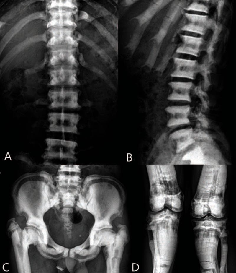 This composite of diagnostic X-ray radiographs (A–D) illustrates systemic bone sclerosis and metabolic bone disease, consistent with osteopetrosis. Panels A and B show the thoracolumbar spine and ribs, demonstrating diffusely increased bone density and a characteristic 'sandwich vertebrae' (or 'layer cake') appearance, where sclerotic bands involve the superior and inferior endplates of the vertebral bodies. Transverse fracture lines are visible in the ribs. Panel C presents a pelvic X-ray revealing marked sclerosis of the ilia, pubis, and ischium, with visible low-density zones. Significant structural abnormalities include shortening of the bilateral femoral necks, superior displacement of the femoral shafts, and transverse fractures of the proximal femurs. Panel D displays the bilateral knees, exhibiting intense bone mineral density and multiple transverse fracture lines across the proximal tibiae and fibulae. These findings represent a classic presentation of Albers-Schönberg disease, emphasizing the increased fracture risk despite increased radiodensity. The images serve as an educational resource for identifying metabolic bone disorders through hallmark radiological signs like 'bone-within-bone' and 'sandwich' vertebrae.