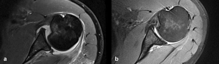 Two side-by-side axial T2-weighted or proton density fat-saturated MRI scans of the shoulder demonstrating the progression of a reverse Hill-Sachs lesion (RHSL) and posterior glenohumeral instability. Image (a) shows the immediate posttraumatic state, characterized by an acute impaction fracture of the anterior humeral head (reverse Hill-Sachs defect) and a concomitant posterior bony Bankart lesion. Image (b) shows the same joint after 5 years of conservative treatment. Comparison reveals morphological changes: the reverse Hill-Sachs defect demonstrates a decrease in depth and filling, likely through fracture hematoma consolidation and cortical remodeling. The posterior bony Bankart lesion shows signs of consolidation. However, both images demonstrate persistent static posterior glenohumeral decentering, where the humeral head remains abnormally positioned posteriorly relative to the glenoid fossa. This visual progression is clinically significant for evaluating the outcomes of conservative management in posterior shoulder instability and the risk of developing posterior decentering osteoarthritis.