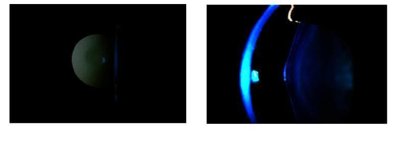This clinical ophthalmic photograph illustrates anterior lenticonus, a diagnostic sign frequently associated with Alport syndrome. The composite image consists of two views: a slit-lamp biomicroscopy photograph (left) and a retroillumination photograph (right) of the right eye. The slit-lamp view utilizes a narrow cobalt blue beam to profile the crystalline lens, revealing a characteristic localized, conical protrusion or bulge on the anterior capsule surface. The retroillumination technique on the right highlights the 'oil droplet' appearance typical of this condition, where the conical deformity of the lens refracts light differently from the surrounding lens matter. These visual findings demonstrate the irregular lens curvature and associated optical reflections, which are critical for the clinical diagnosis of anterior lenticonus. This educational material is intended for ophthalmology students and residents to differentiate lens surface abnormalities from typical lenticular morphology.