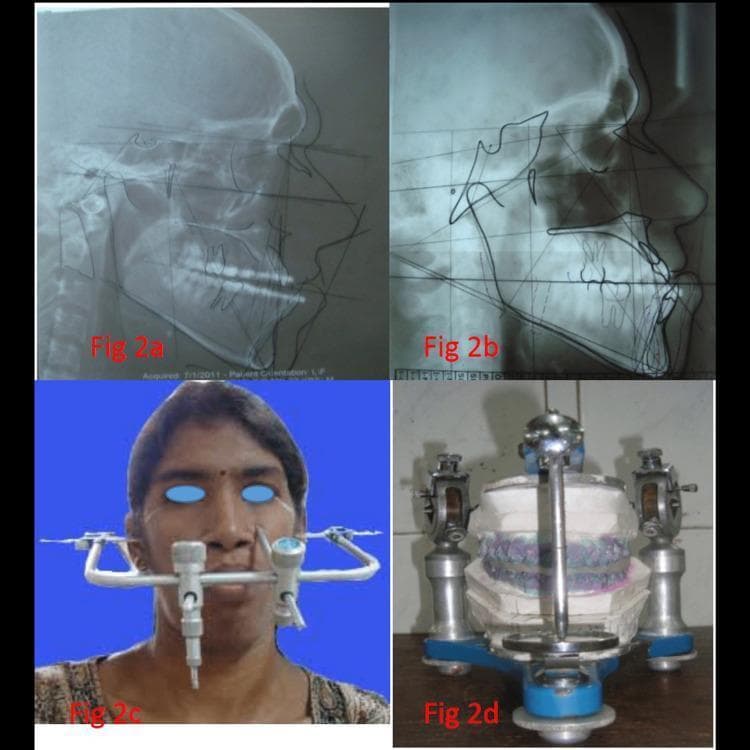 This four-panel composite image illustrates the preoperative planning and surgical simulation stages for orthognathic surgery. Panels (a) and (b) show lateral cephalometric radiographs utilized for cephalometric analysis. Panel (a) is a preoperative radiograph with initial tracings, while panel (b) displays a prediction tracing (VTO - Visualized Treatment Objective), superimposing planned skeletal and dental movements onto the baseline profile. Key landmarks and reference planes (such as the Frankfort horizontal and mandibular plane) are delineated to assess jaw relationship and dental compensation. Panel (c) is a clinical photograph showing the clinical application of a face-bow on a patient to record the spatial relationship of the maxillary arch to the temporomandibular joints. Panel (d) shows the subsequent laboratory phase, where dental casts are mounted on a semi-adjustable articulator for model surgery and the fabrication of a surgical splint. This sequence demonstrates the integrated workflow of diagnostic imaging, cephalometric prediction, and mechanical simulation essential for correcting dentofacial deformities.
