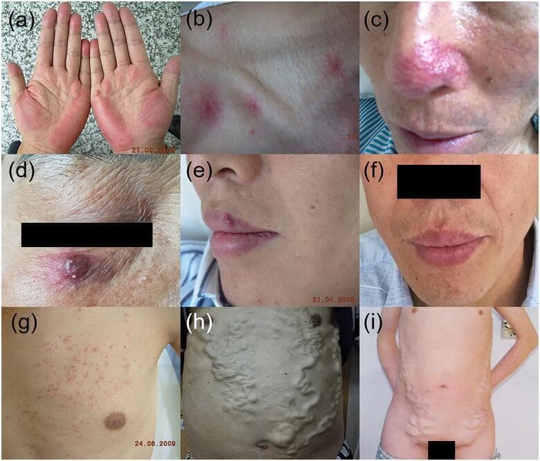 This composite of clinical photographs illustrates various cutaneous vascular manifestations of chronic liver disease and portal hypertension. (a) Palmar erythema, showing bilateral symmetric redness over the thenar and hypothenar eminences. (b, c) Spider angiomata on the chest and nose, appearing as central red arterioles with radiating capillary 'legs'. (d, e, f) Arteriovenous haemangioma presenting as a raised, reddish-purple nodule on the face, with (e) and (f) demonstrating lesion regression over time. (g) Paper money skin on the upper torso, characterized by numerous fine, thread-like telangiectasias reminiscent of security threads in currency. (h) Caput medusa, exhibiting severe, tortuous dilatation of the paraumbilical veins radiating from the umbilicus due to portal-systemic shunting. (i) Abdominal varicose veins associated with inferior vena cava obstruction syndrome, showing prominent, vertically-oriented collateral veins on the lateral and lower abdominal wall. These images serve as diagnostic markers for hepatobiliary pathology and related hemodynamic alterations.